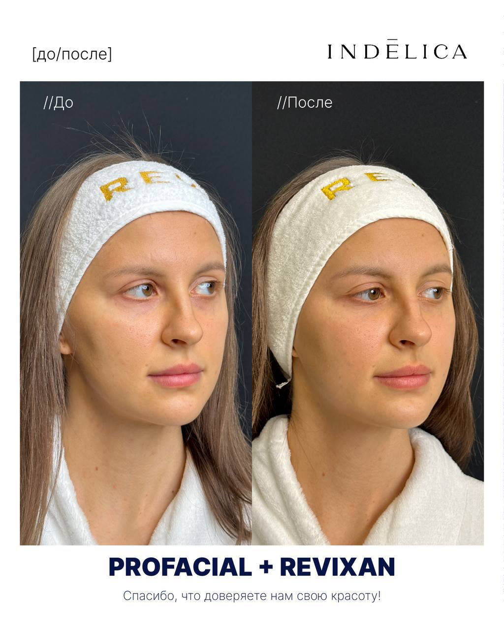 Чистка ProFacial · до / после