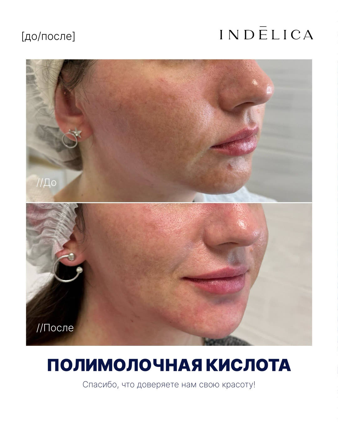 Контурная пластика лица · до / после