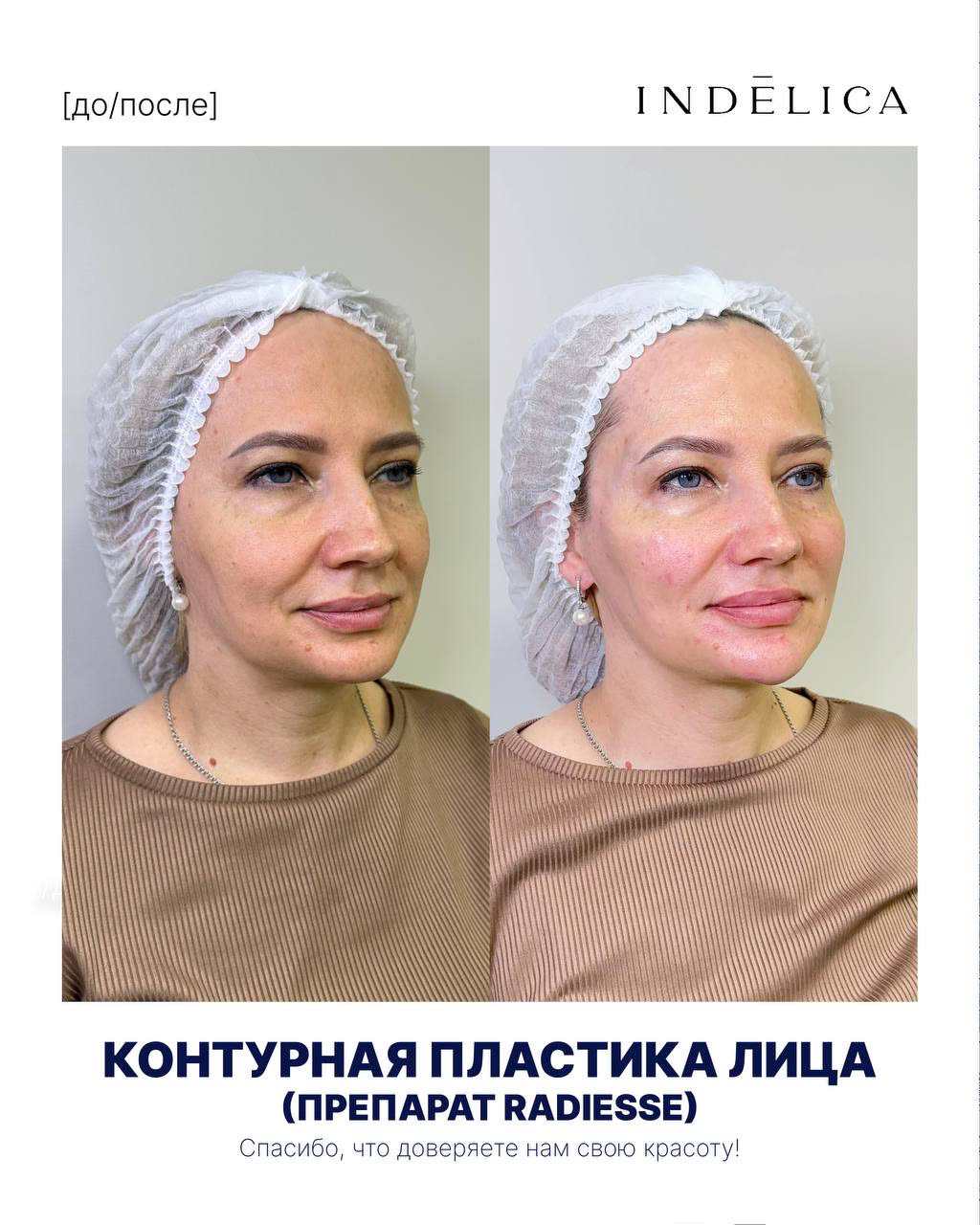 Контурная пластика лица · до / после