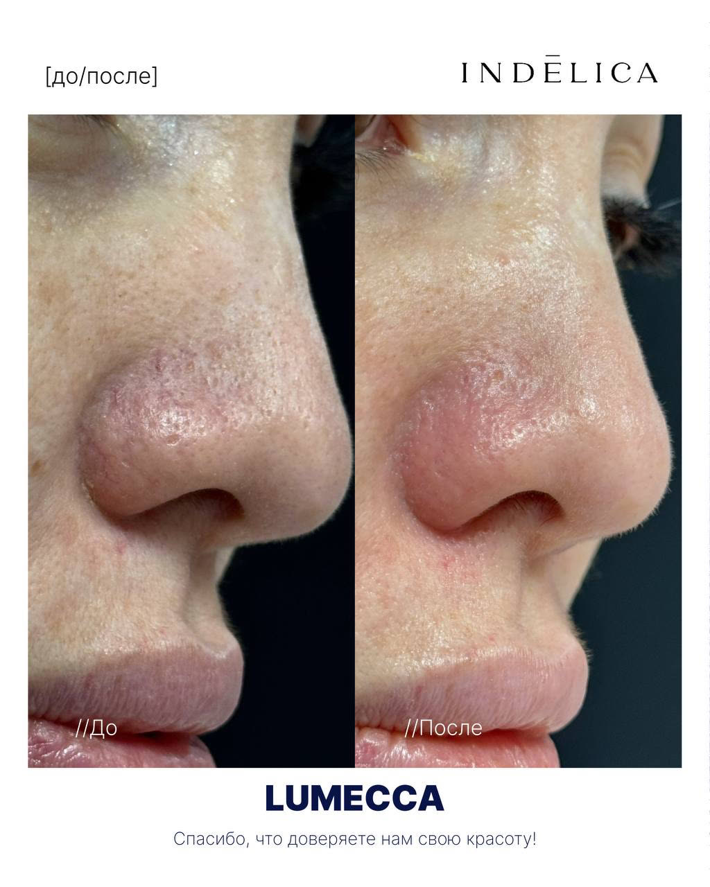 Фотоомоложение Lumecca · до / после