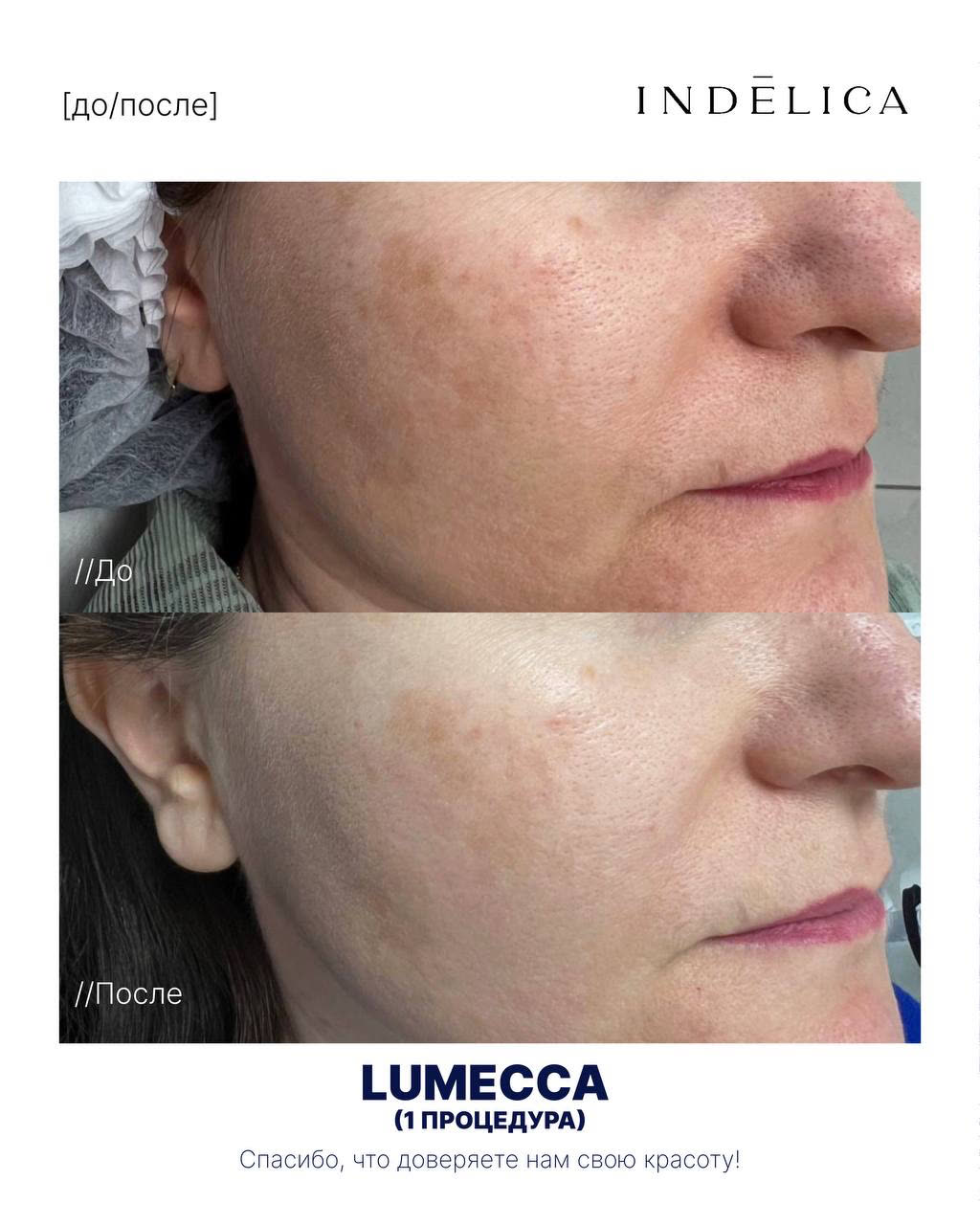 Фотоомоложение Lumecca · до / после