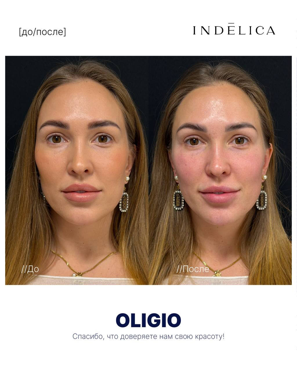 RF-лифтинг Oligio · до / после
