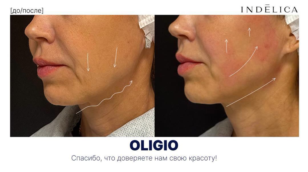 RF-лифтинг Oligio · до / после