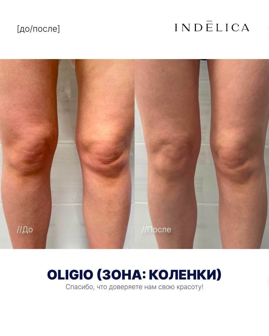 RF-лифтинг Oligio · до / после