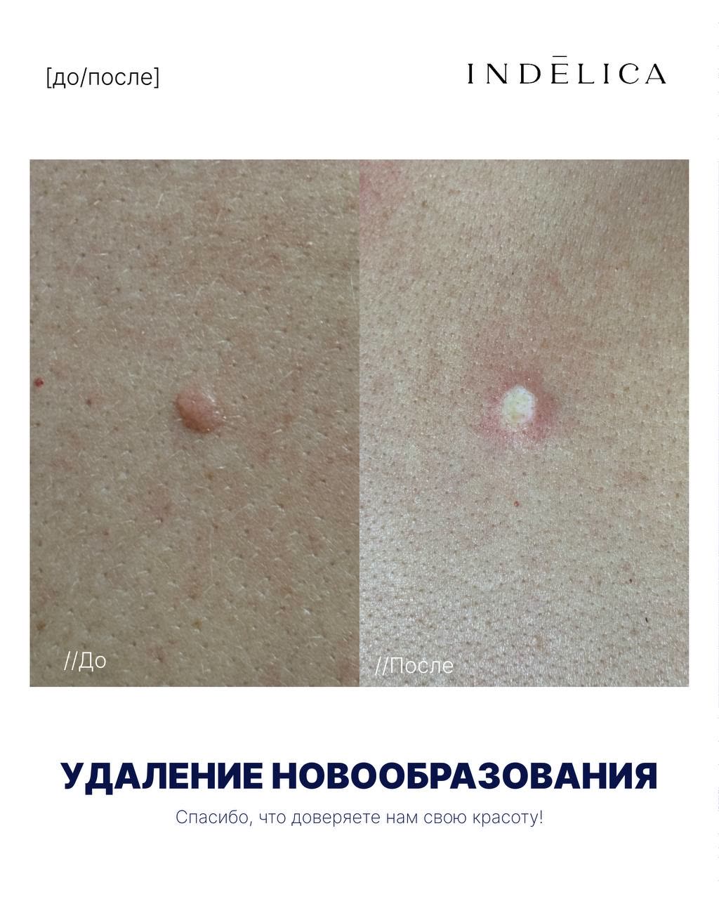 Удаление новообразований · до / после