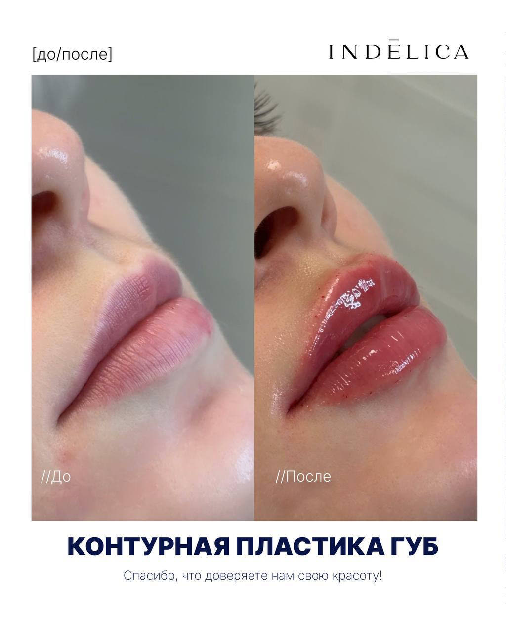 Контурная пластика губ · до / после