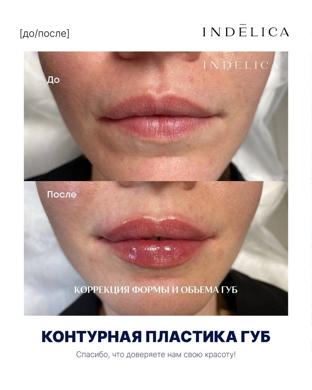 Контурная пластика губ · до / после
