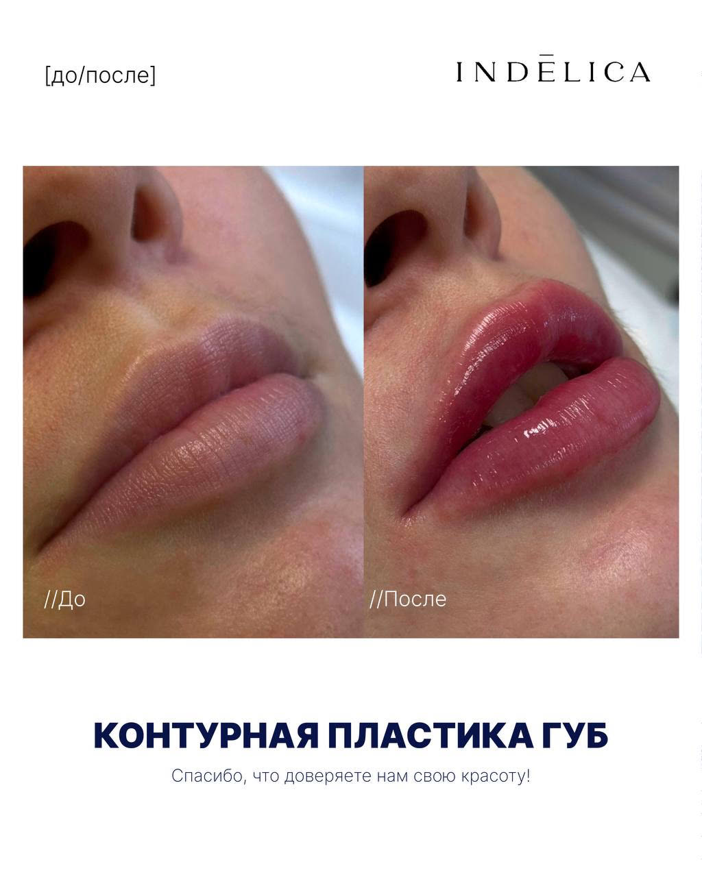 Контурная пластика губ · до / после