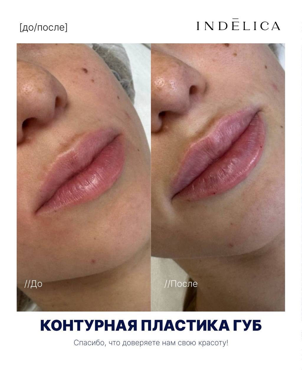 Контурная пластика губ · до / после