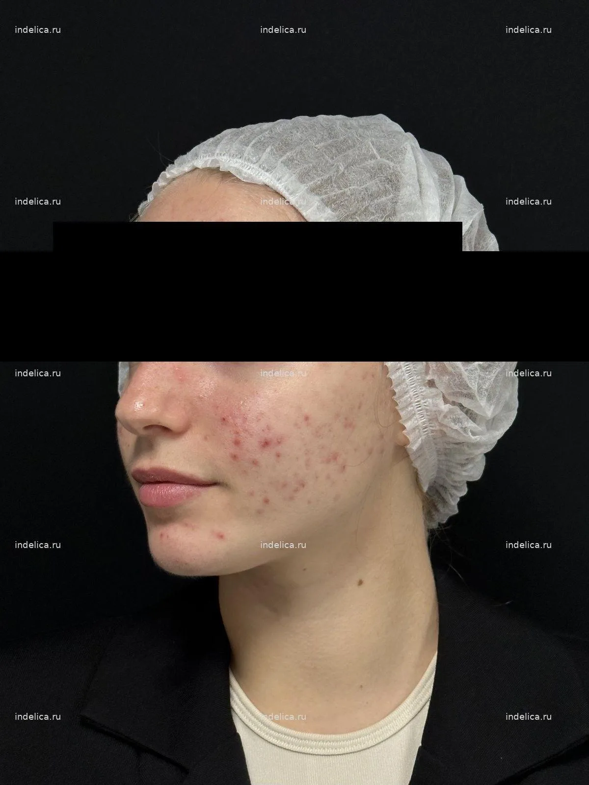 Фото до — лечение акне — клиника Indelica Самара