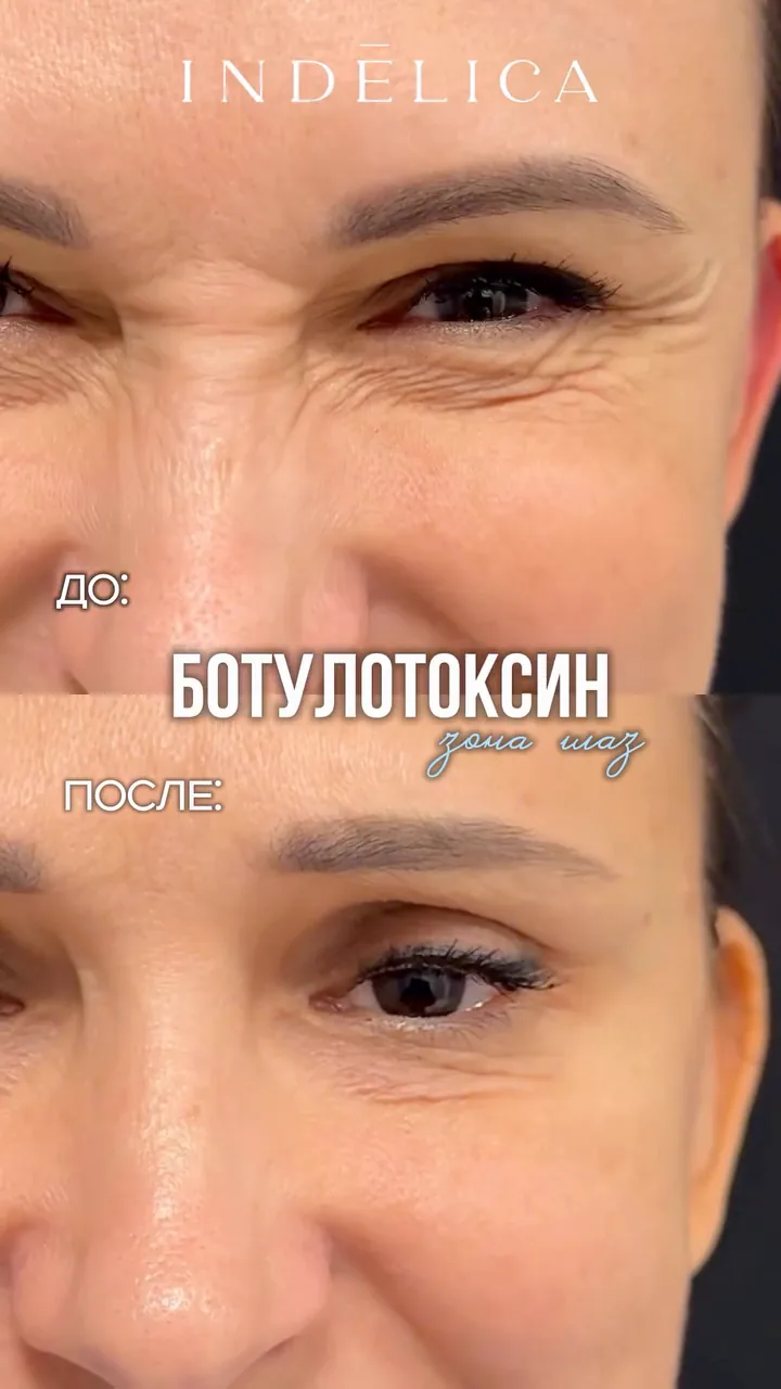Ботулинотерапия · до / после