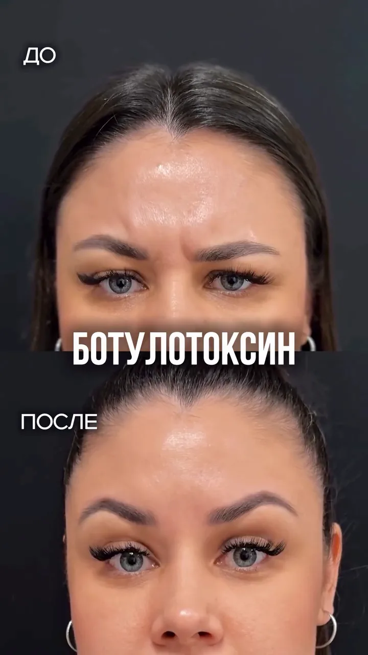 Ботулинотерапия · до / после