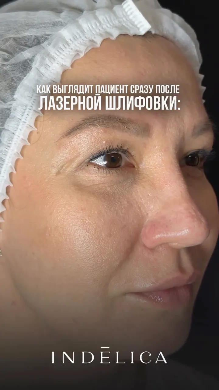 Лазерная шлифовка