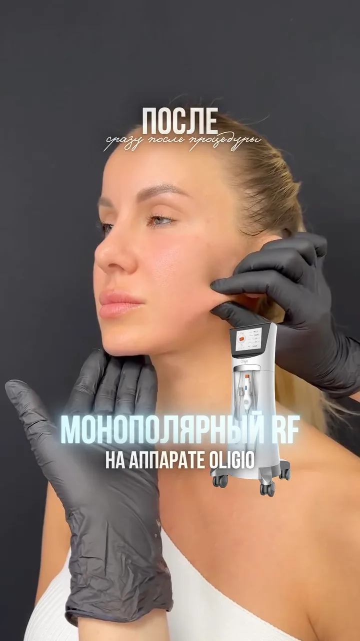 RF-лифтинг Oligio · до / после