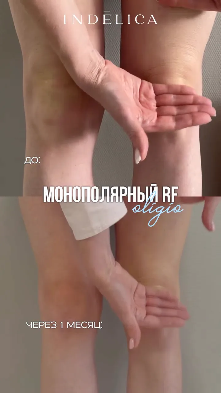RF-лифтинг Oligio · до / после