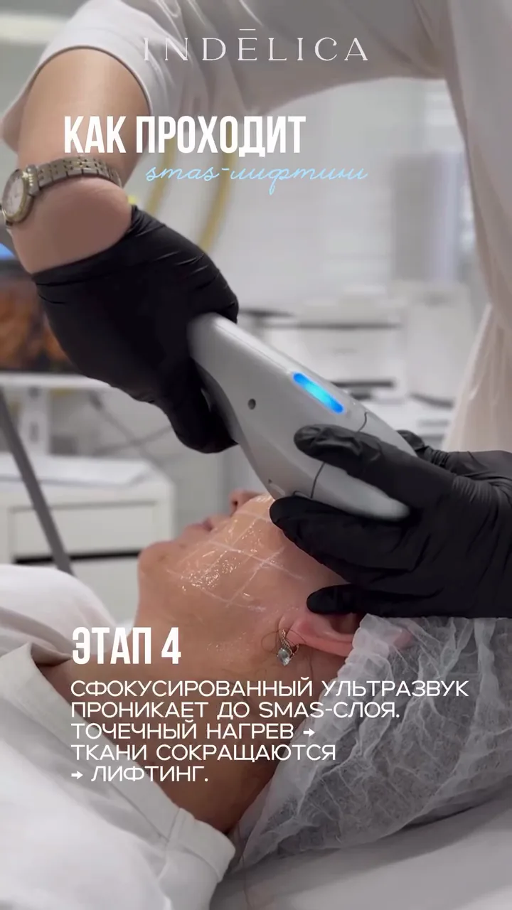 SMAS Ultraformer · как проходит