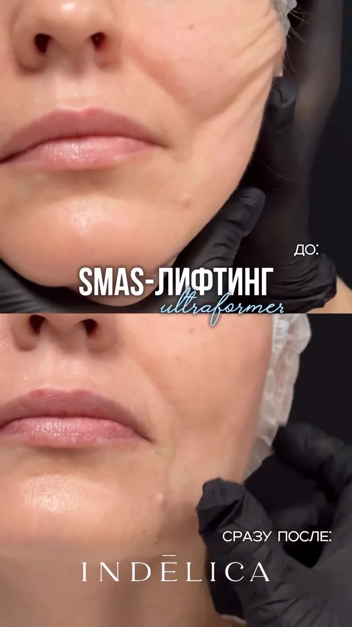 SMAS-лифтинг · до / после